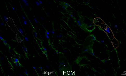 Fluorescence microscopy image of cardiac muscle tissue (green: cell structure, blue: cell nuclei), each panel showing one elongated cell highlighted in false colour (white on the left, red with yellow markers on the right). The right-hand image is labelled "HCM" and shows tissue from hypertrophic cardiomyopathy, compared with the control image on the left. Scale bar: 40 µm.