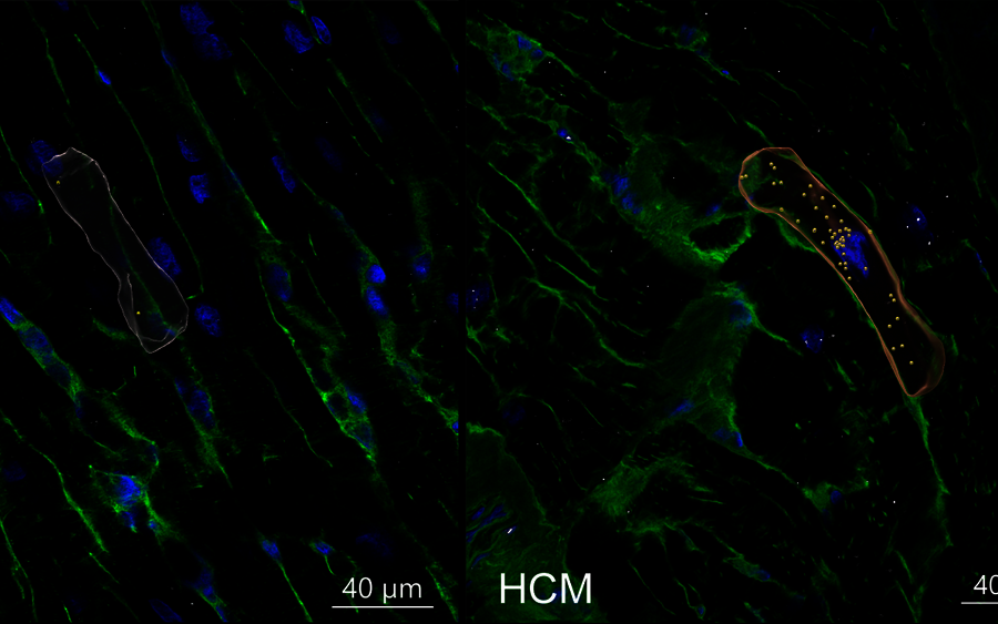 Fluoreszenzmikroskopische Aufnahme von Herzmuskelgewebe (grün: Zellstruktur, blau: Zellkerne) mit jeweils einer hervorgehobenen, länglichen Zelle in Falschfarben (links weiß, rechts rot mit gelben Markierungspunkten). Die rechte Aufnahme ist mit „HCM" beschriftet und zeigt Gewebe bei hypertropher Kardiomyopathie im Vergleich zur linken Kontrollaufnahme. Maßstabsbalken: 40 µm