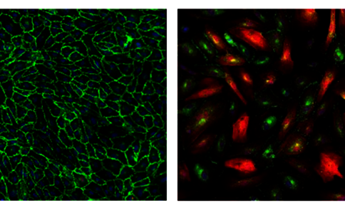 Endothelzellen unter dem Fluoreszenzmikroskop: links gesunde, dicht gepackte Zellen mit grünen Zellgrenzen, rechts umgewandelte, längliche Zellen mit roten Fasern und Lücken.