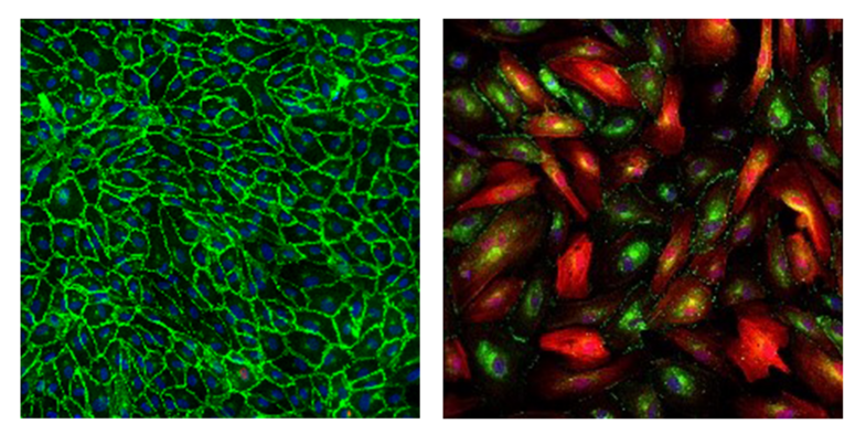 Endothelial cells under a fluorescence microscope: left, healthy tightly packed cells (green); right, cells pathologically transformed into connective-tissue-like cells (red) that have lost cohesion.